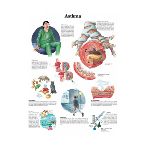 Slightly Damaged, Chart Understanding Asthma, Each