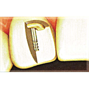Op Po Temporary Posts White 0.9mm 20/pk Pack